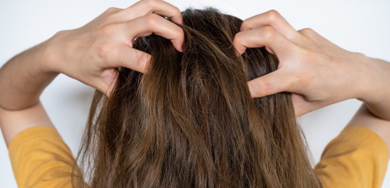 How to Effectively Reduce Dandruff?