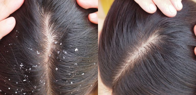 You can now address your Dandruff With Trichoderm – Available in Singapore